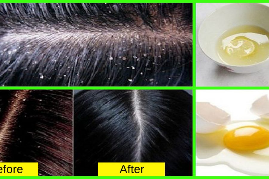 How To Get Rid Of Dandruff – Eliminate Flaking Scalp Issues